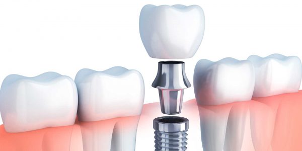 Temprano Dental implante dental